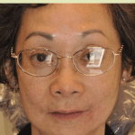 Patient2-Photo1