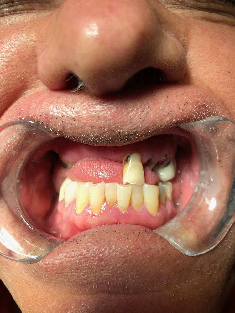 Patient3Photo2Intraoral