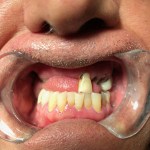Patient3Photo2Intraoral