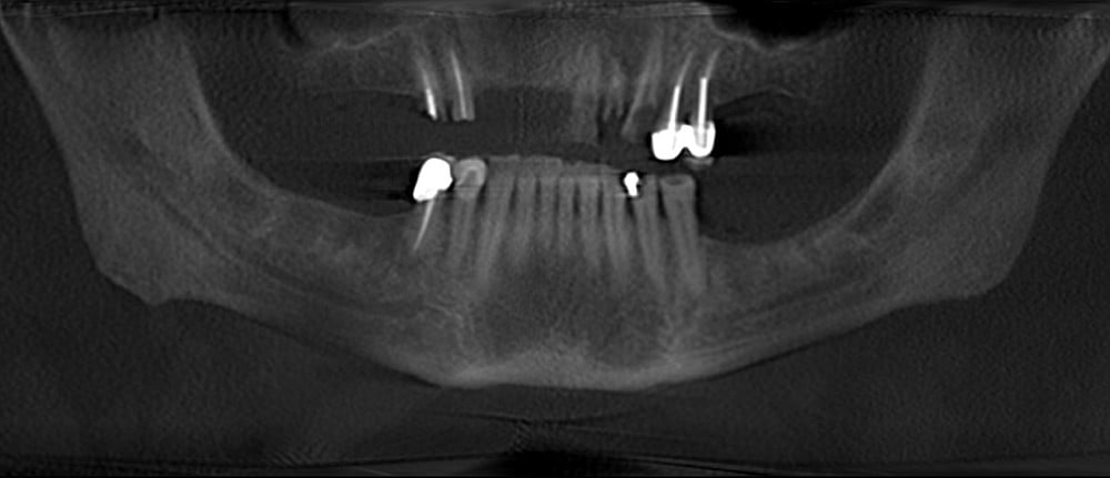 Patient3Photo3PreopPano