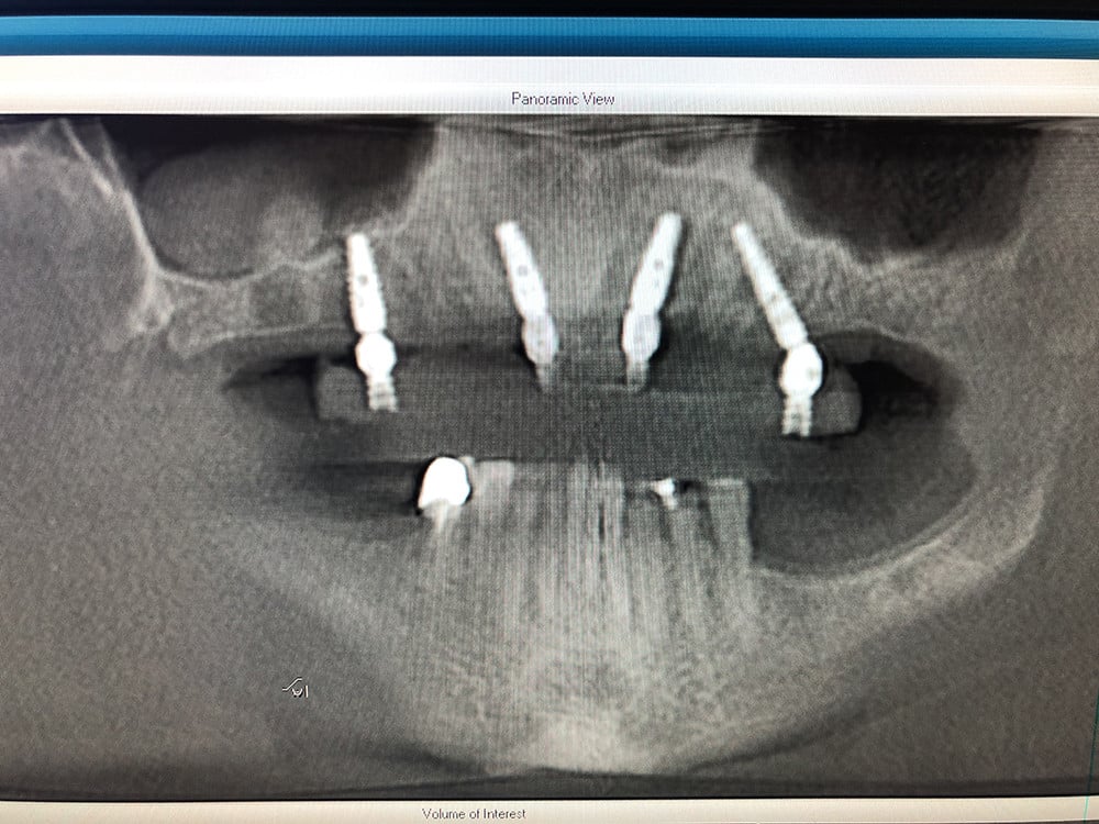 Patient3Photo9PostopXrays