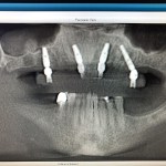 Patient3Photo9PostopXrays